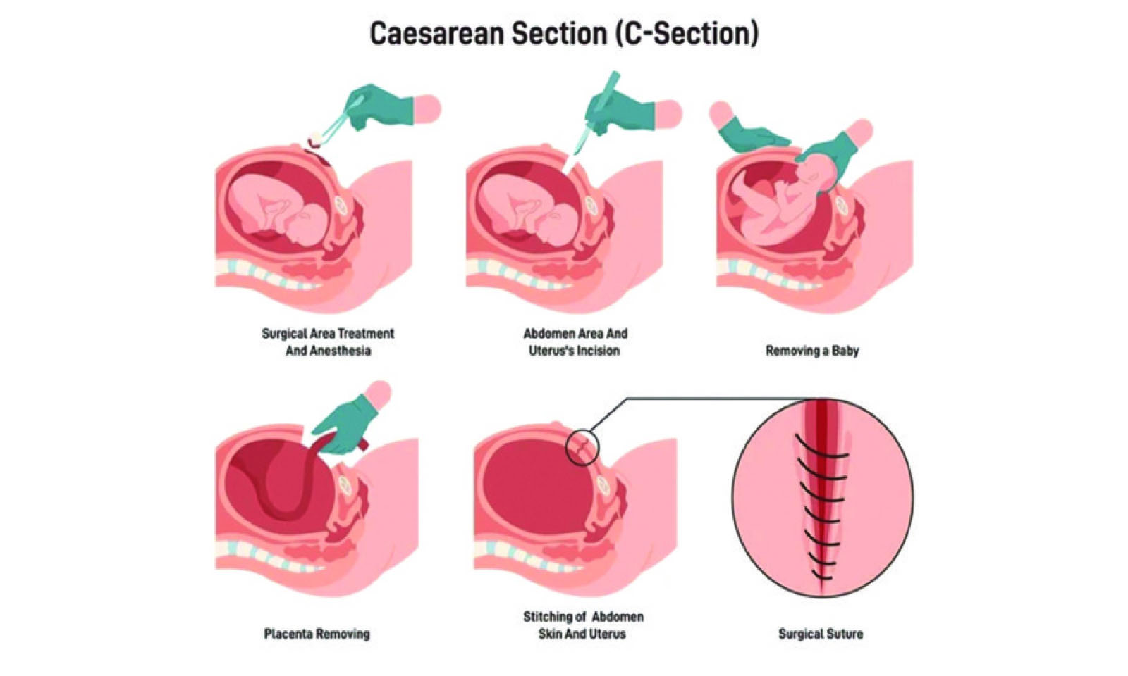 C-section surge — Are women choosing convenience over nature?