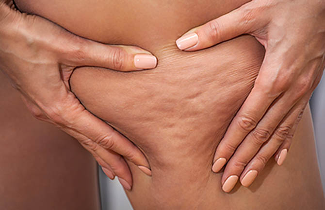 How to get rid of cellulite