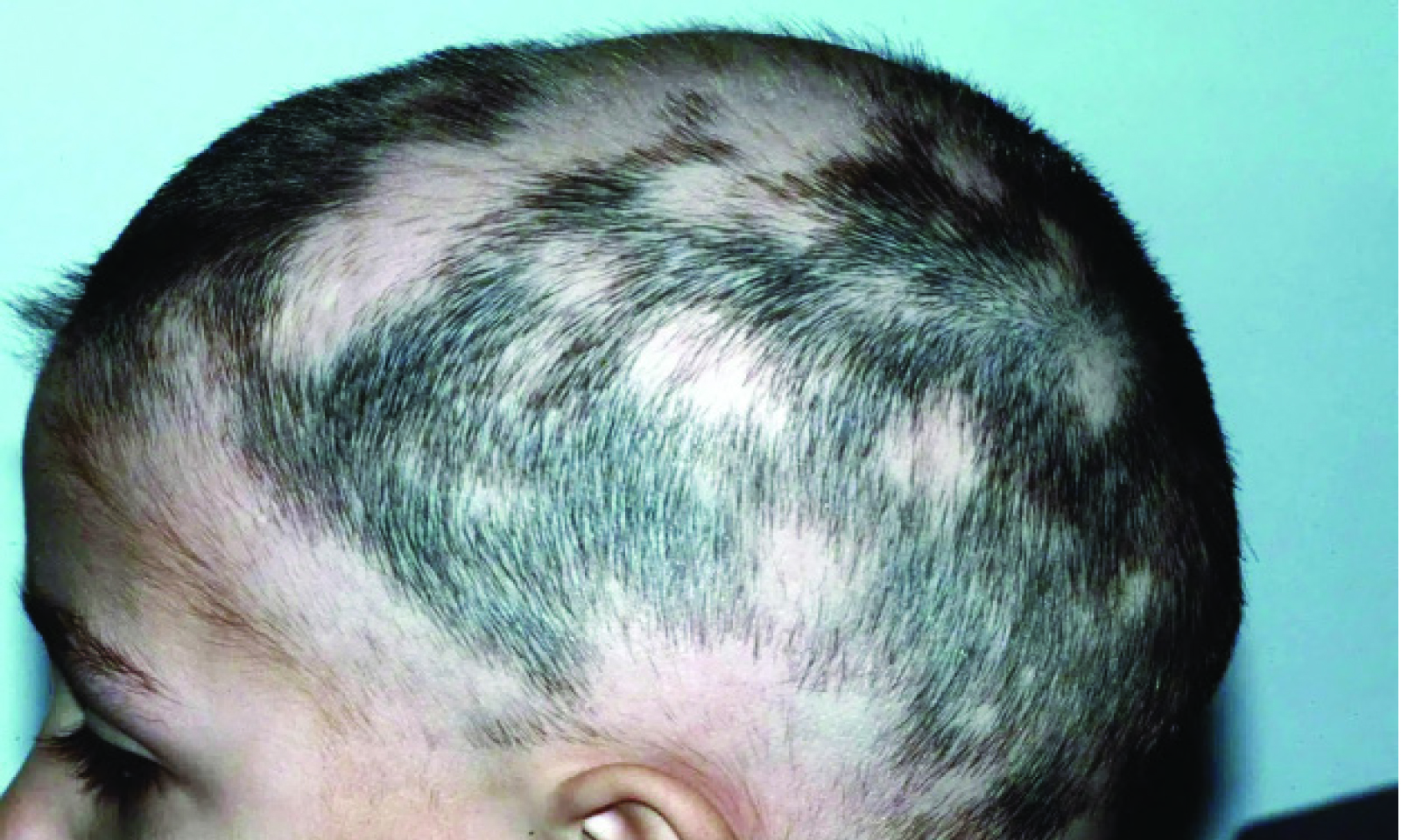 Alopecia and the hidden toll on women’s self-esteem, identity