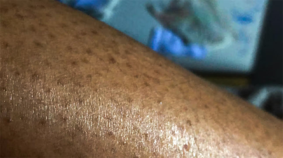 How to tackle clogged pores for smooth skin