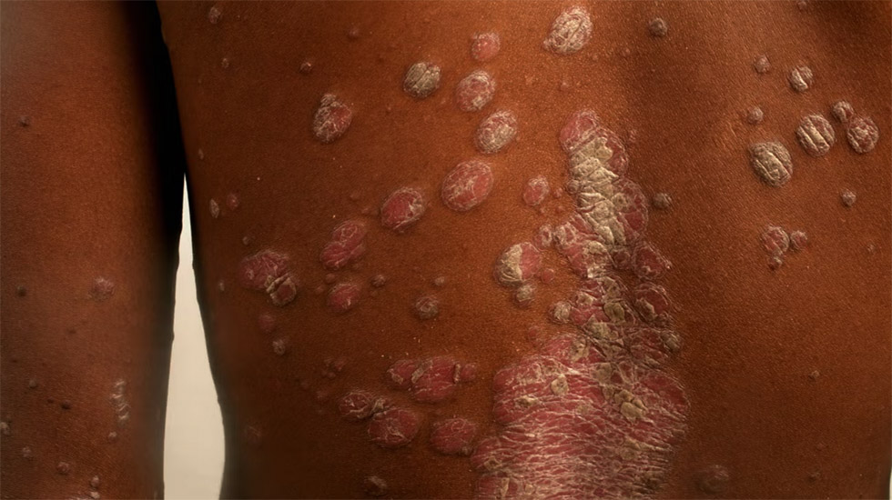 The combination of heat, sweating, and exposure to dirty water can trigger skin problems such as fungal infections, rashes, and boils