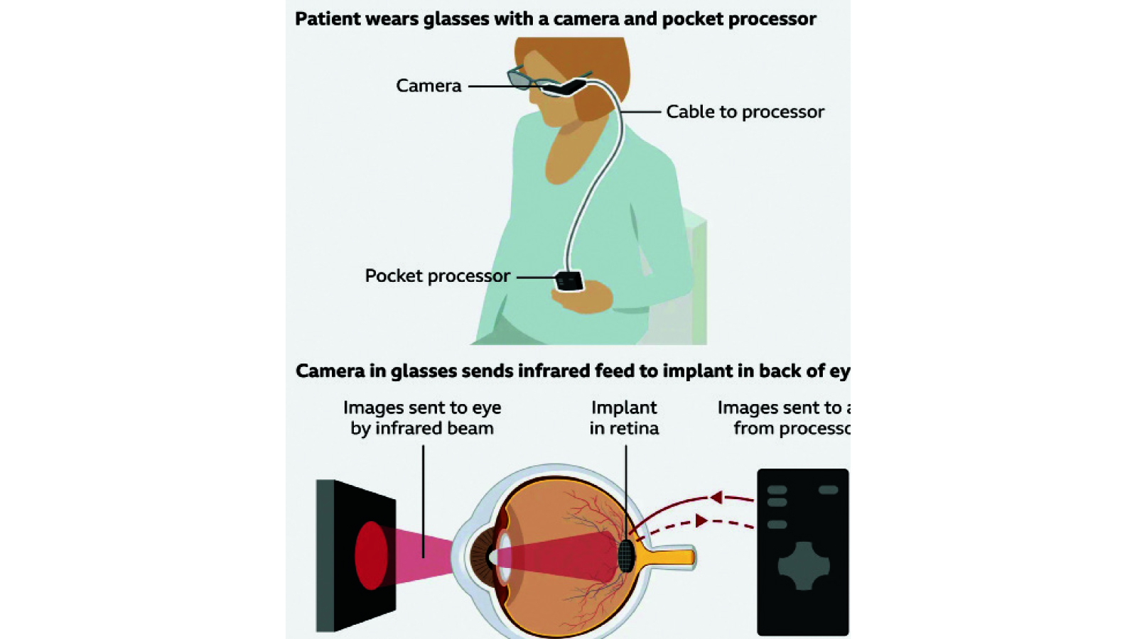 LIFE-CHANGING IMPLANT HELPING THE BLIND READ AGAIN