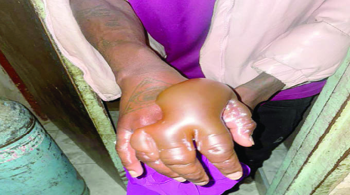 NO FIRE BUT GAS BURNS BYO MAN: Bizarre mishap leaves victim in hospital