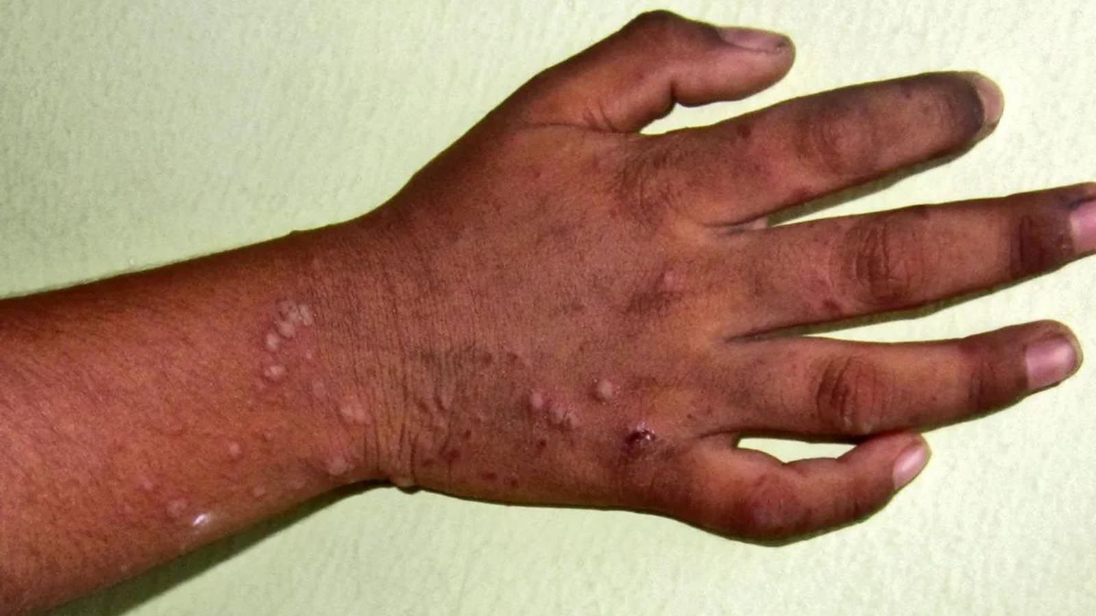 Chirwere cheHand, Foot and Mouth Disease chanyuka muHarare