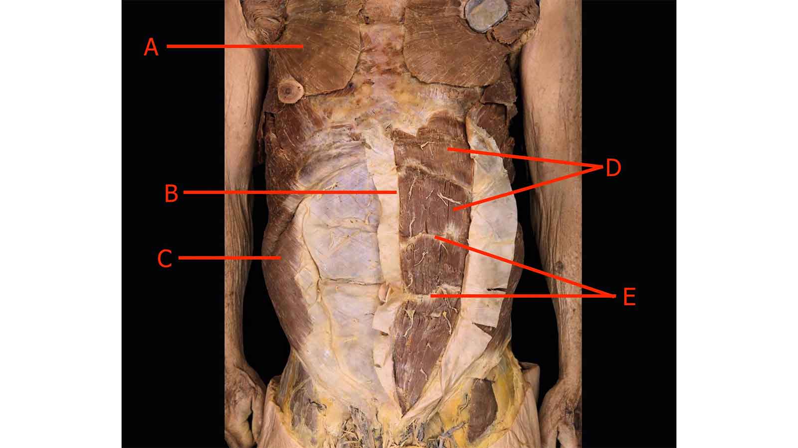 UZ appeals for more cadaver donations
