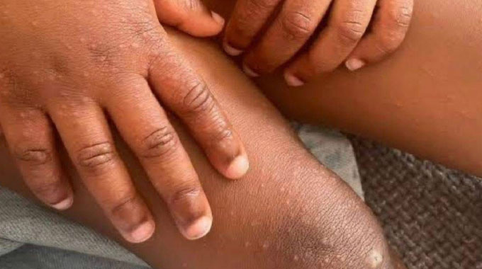 Hand, foot & mouth disease: Know the signs, protect your child