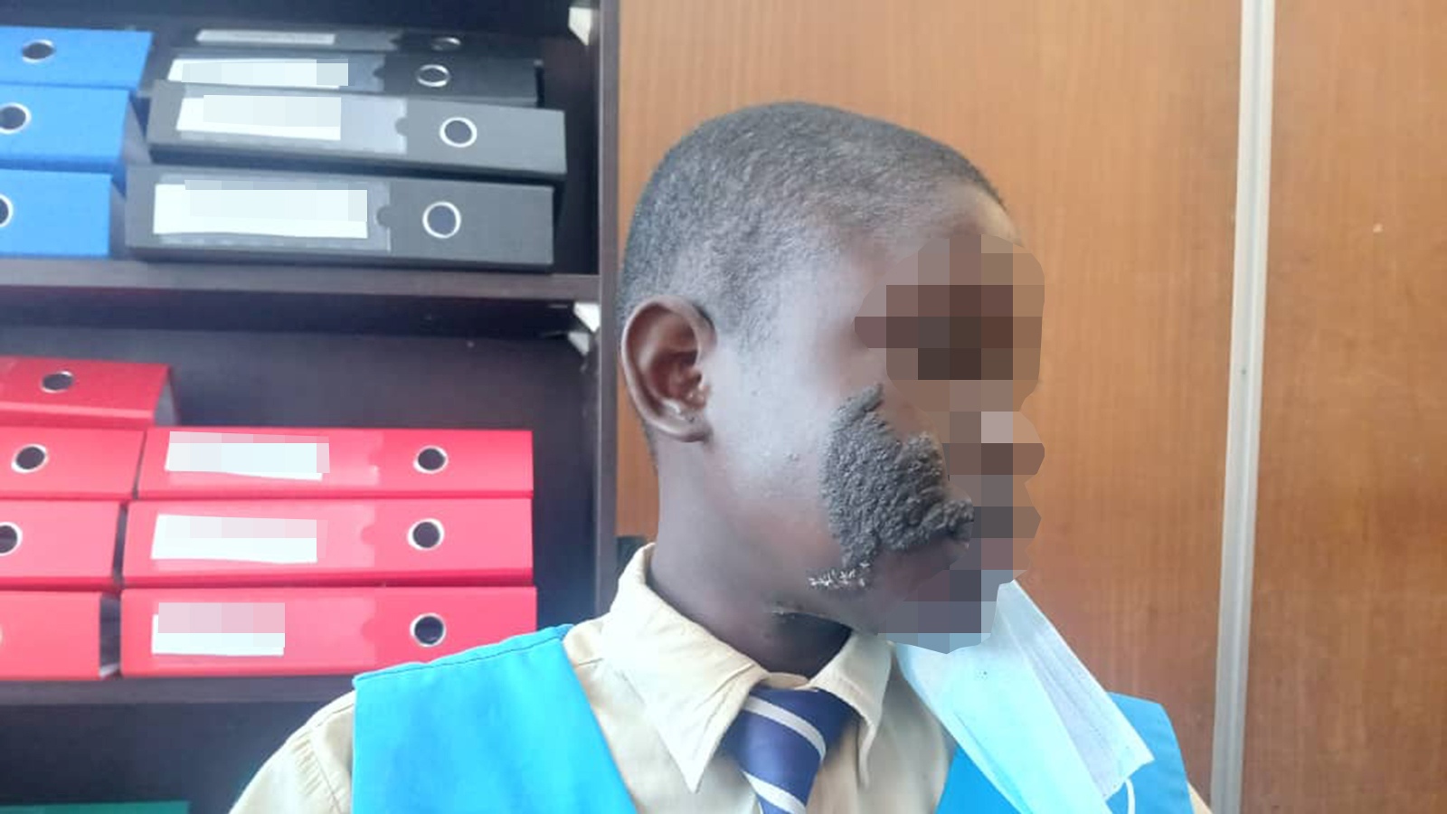 Mwanasikana ane chirwere cheganda otsvaga rubatsiro