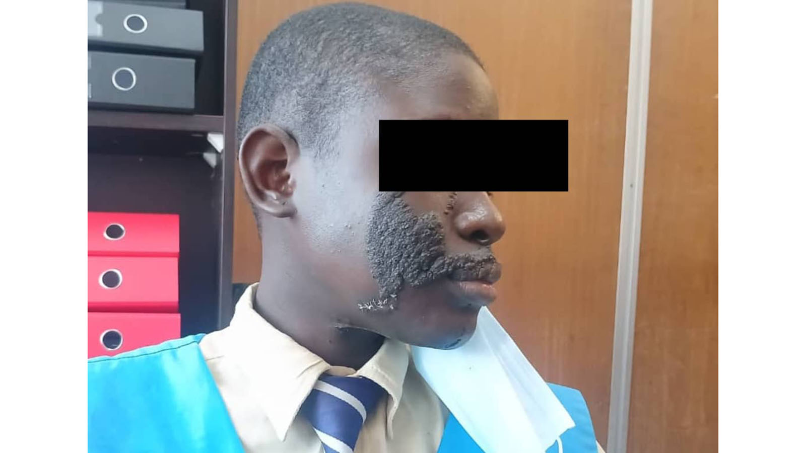 NEW: Girl from Chitungwiza seeks US$500 for operation for a rare skin condition