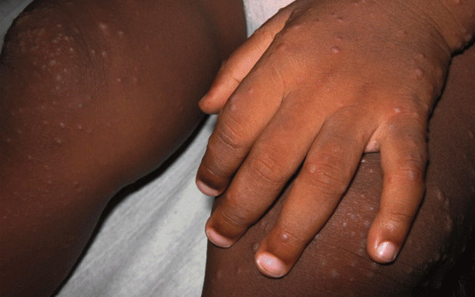 HFMD is a common viral illness that mainly affects children under the age of 10