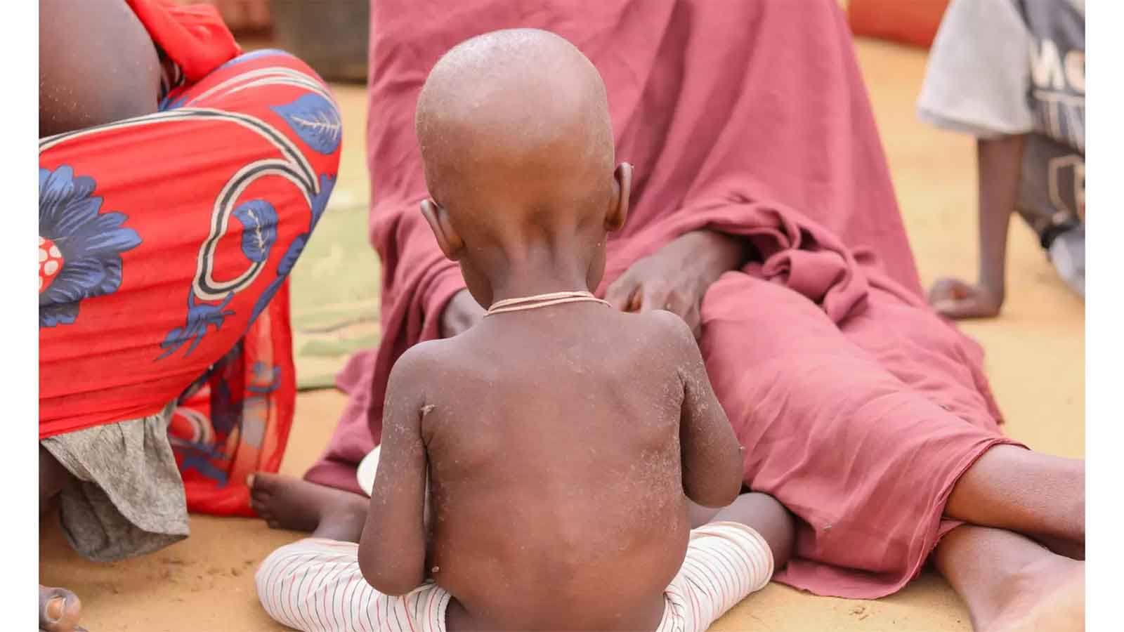 4,2m face malnutrition in Sudan