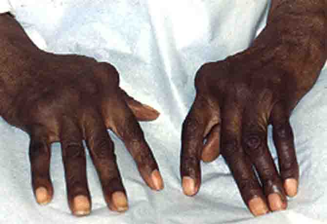 Arthritis simply means inflammation of the joints