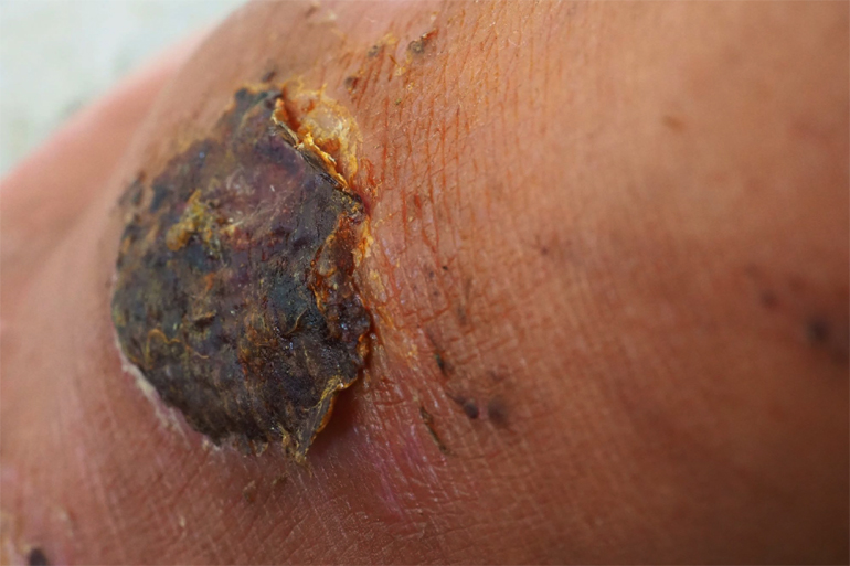 All about wounds that do not heal