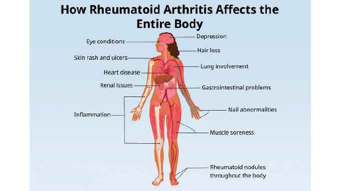 Understanding rheumatoid arthritis, its impact
