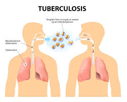 Zimbabwe moves to close gaps in drug-resistant TB treatment