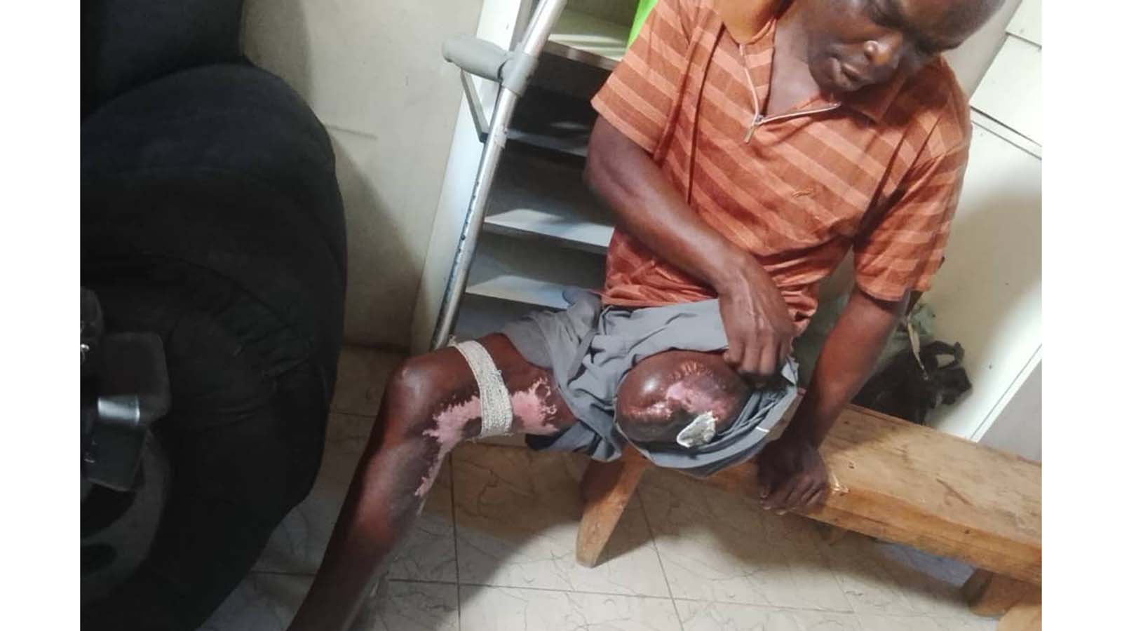 Murume (52) akatsva gumbo nemoto wembaura rikazodamburwa