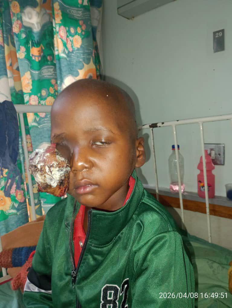 Kezi boy’s battle with rare eye cancer sparks urgent plea for assistance