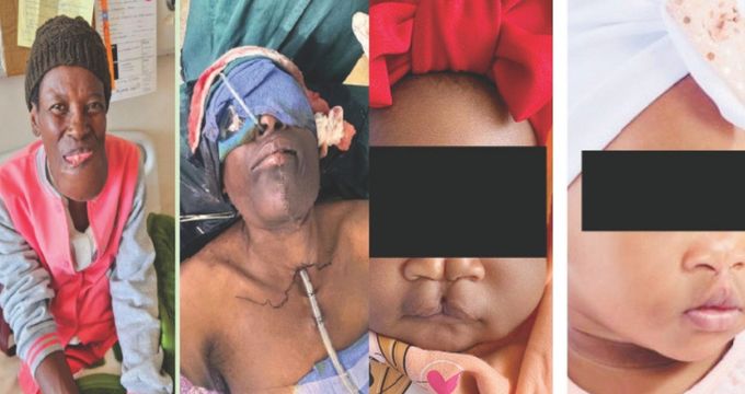 Mpilo restores 90 smiles and confidence