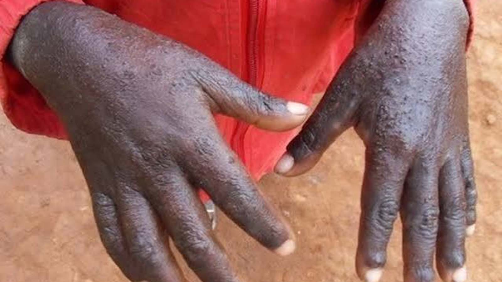 Chirwere chemhezi chanyuka muHarare