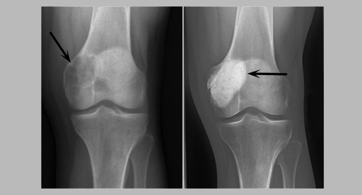 Bone cancer often forgotten
