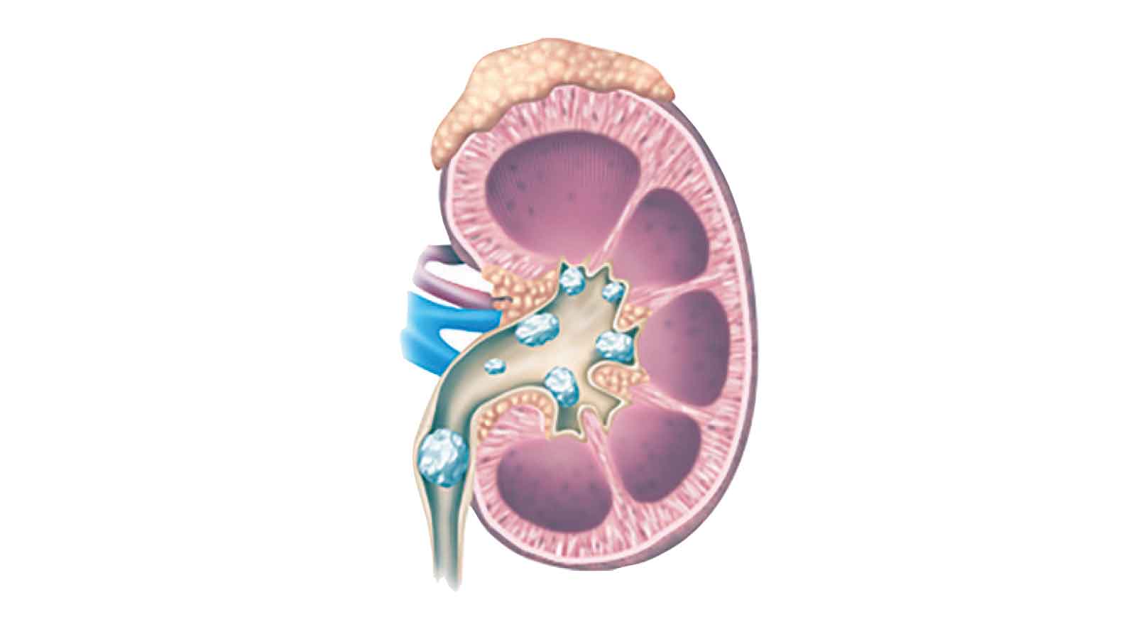 Kidney stones and the painful warning signs not to ignore