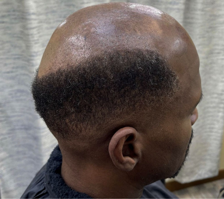 About 20 percent of men start balding by age 20, and about 30 percent do so by age 30