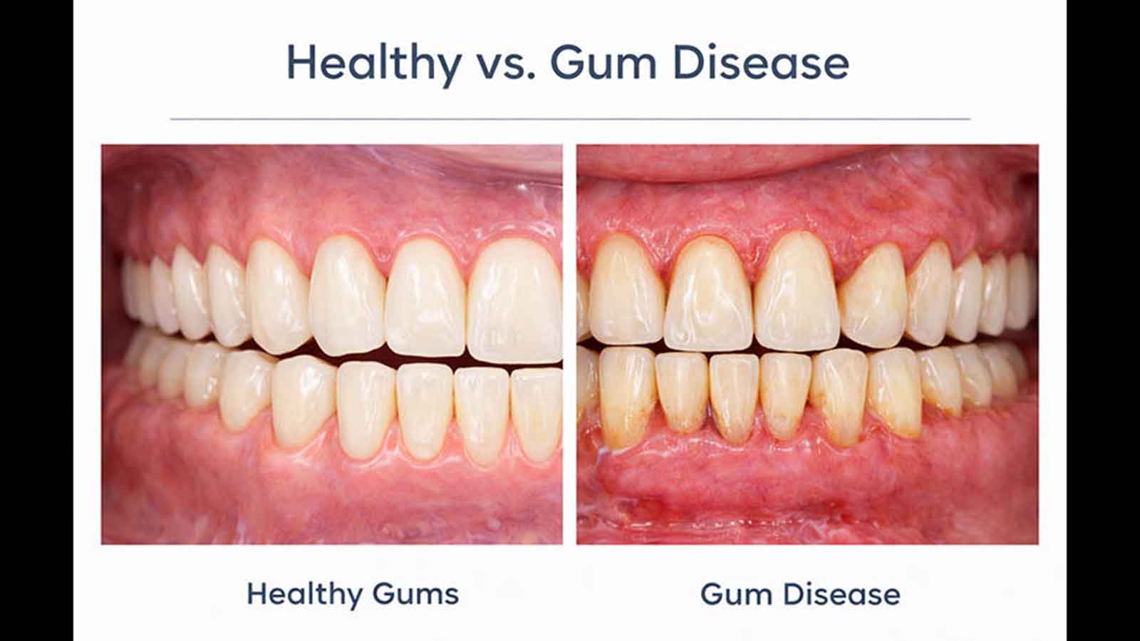 Gum disease: Silent threat hiding behind a smile