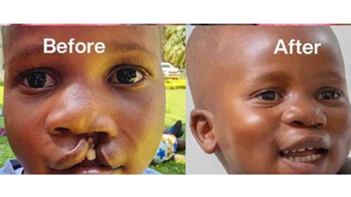 Free cleft surgery camp returns