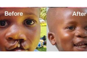Free cleft surgery camp returns