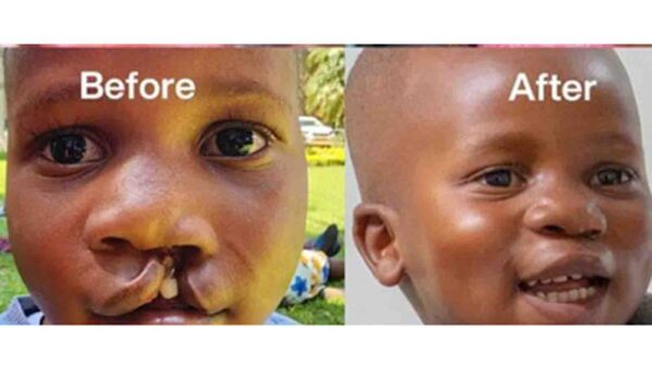 Free cleft surgery camp returns