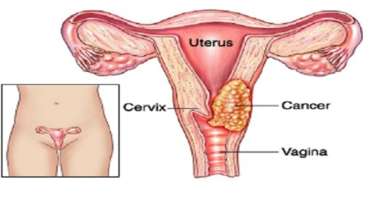 hiv negomarara