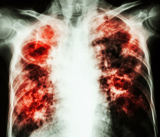 TB: Major global health problem