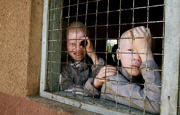 Pupils with albinism ditch classes in Malawi