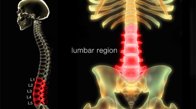 Managing low back pain