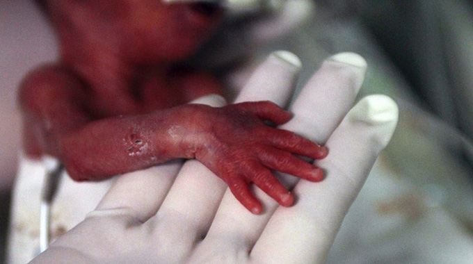 Action needed to avoid death in preterm babies