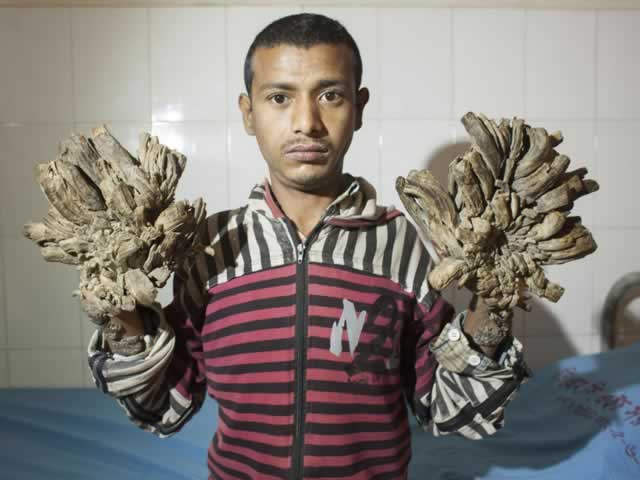 ‘Tree Man’ to undergo surgery to remove warts