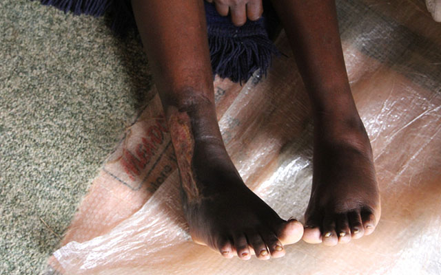A close-up view of Chituwu's injured leg, which has left her virtually incapacitated for close to six months