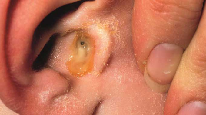 How to cure ear infection