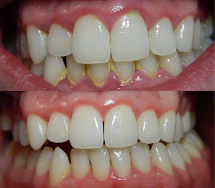 How to deal with gingivitis