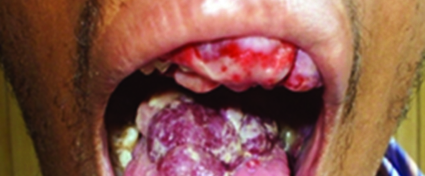 Chii chinonzi Kaposi’s Sarcoma?