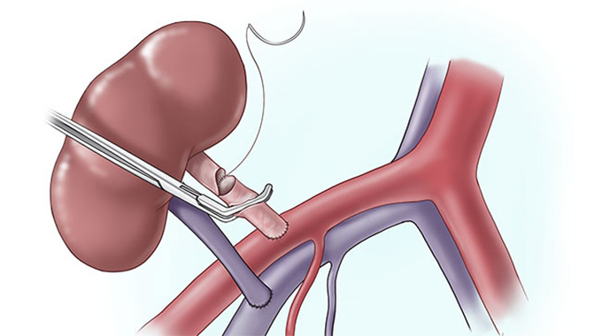 Kidney patient dies before transplant