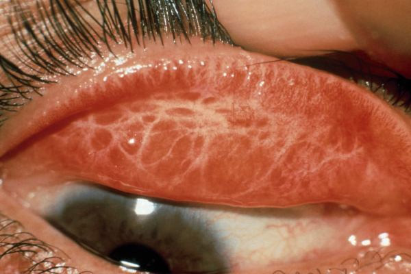 Mutasa and Nyanga more at risk of trachoma