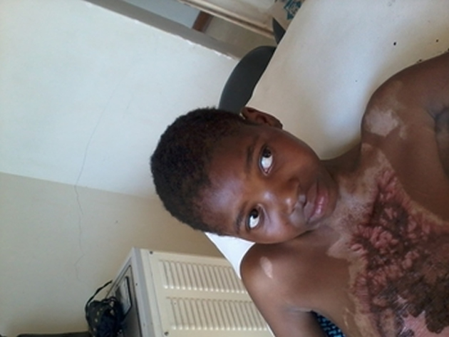Burn victim appeals for help