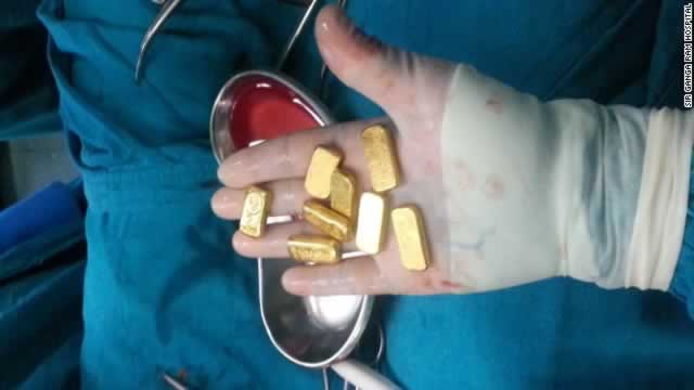 A New Delhi hospital admitted a 63-year-old man on April 8 after he complained of intestinal pain and nausea. The patient, whose name was not released, was hiding 12 gold bars in his belly. He apparently smuggled them into India to evade import duty, police and doctors said.
