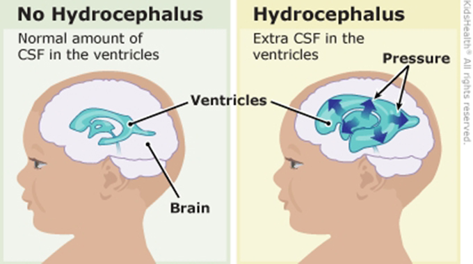 Hydrocephalus cases go unidentified, untreated