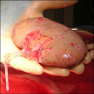 Kidney transplants under consideration