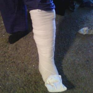 Broken leg triggers US$85 000 lawsuit