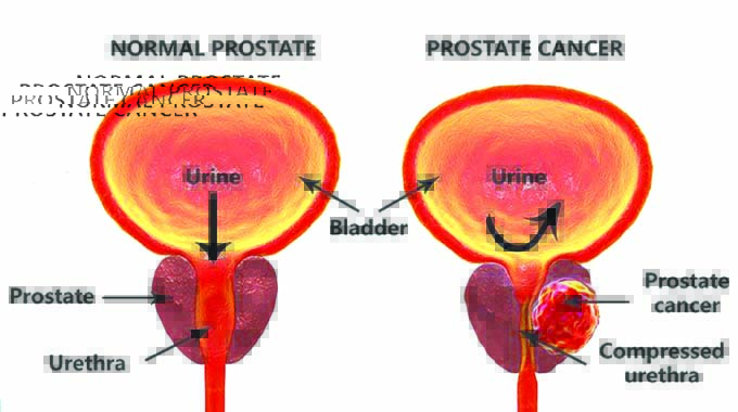 Get to know disorders of the prostate
