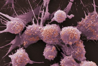 prostate_cancer_cells