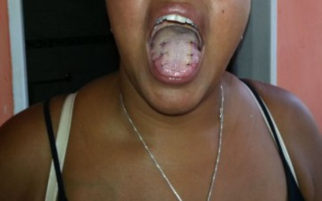 A woman who has been sewn a toungue patch to lose weight