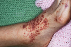 Beware of sources of typhoid fever